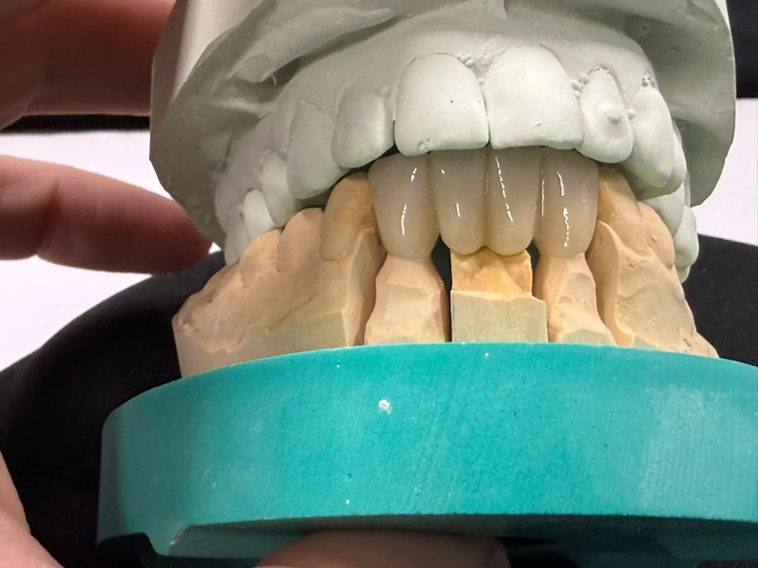 Kruse & Mordhorst Zahntechnik GmbH - Das Bild zeigt eine Zahnbrücke aus Zirkonkeramik, die üblicherweise bei Restaurationen im Dentallabor verwendet wird.