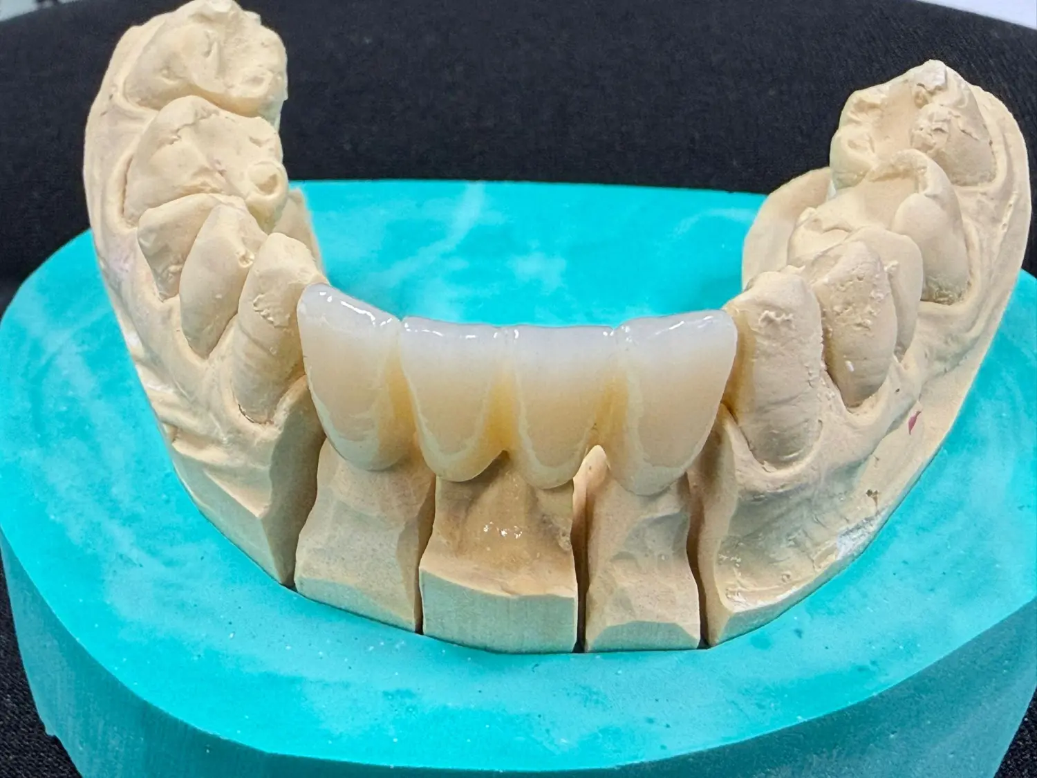 Kruse & Mordhorst Zahntechnik GmbH - Das Bild zeigt eine Zahnbrücke aus Zirkonkeramik, die üblicherweise bei Restaurationen im Dentallabor verwendet wird.