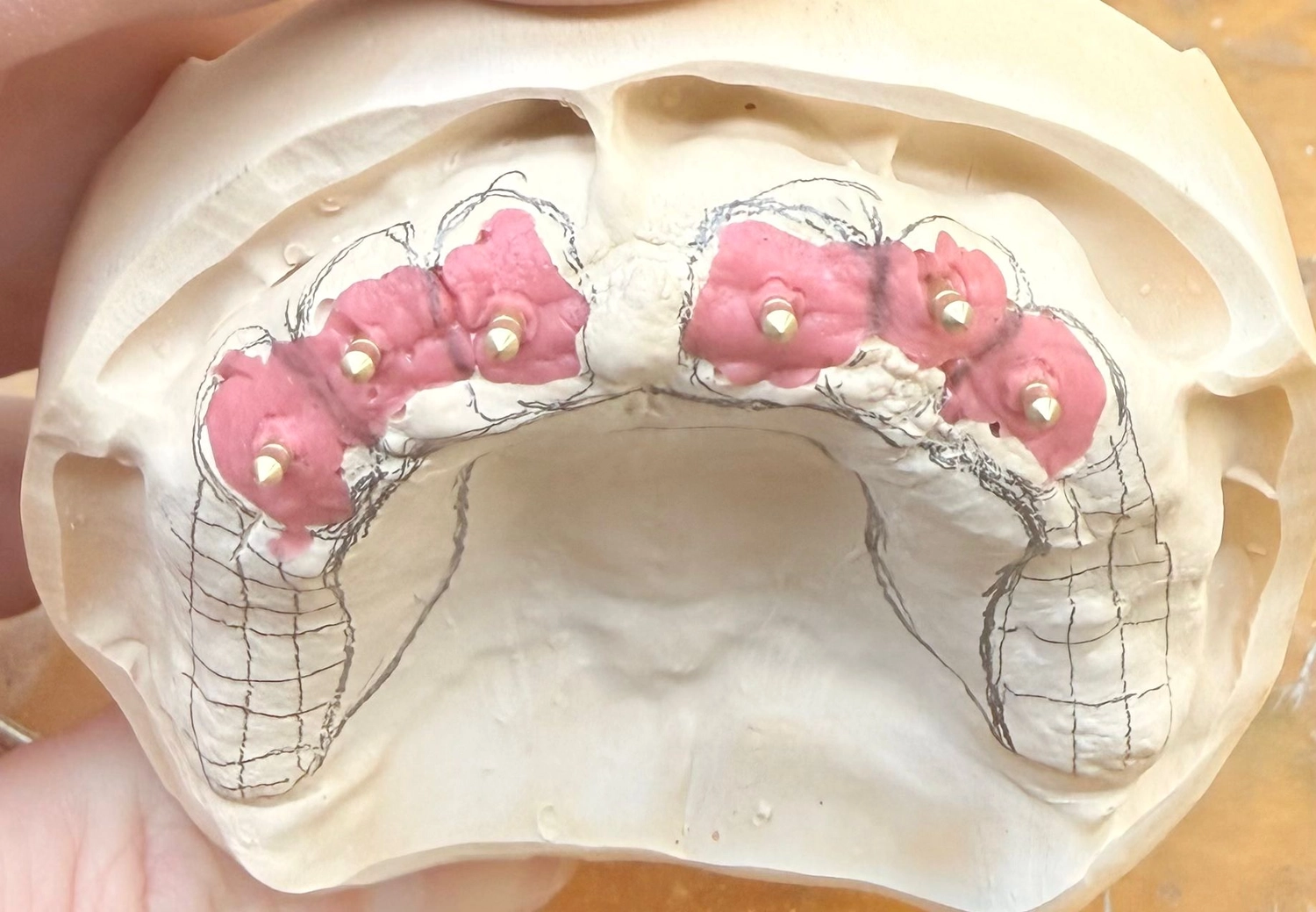 Kruse & Mordhorst Zahntechnik GmbH - Das Bild zeigt eine Zahnbrücke aus Zirkonkeramik, die üblicherweise bei Restaurationen im Dentallabor verwendet wird.