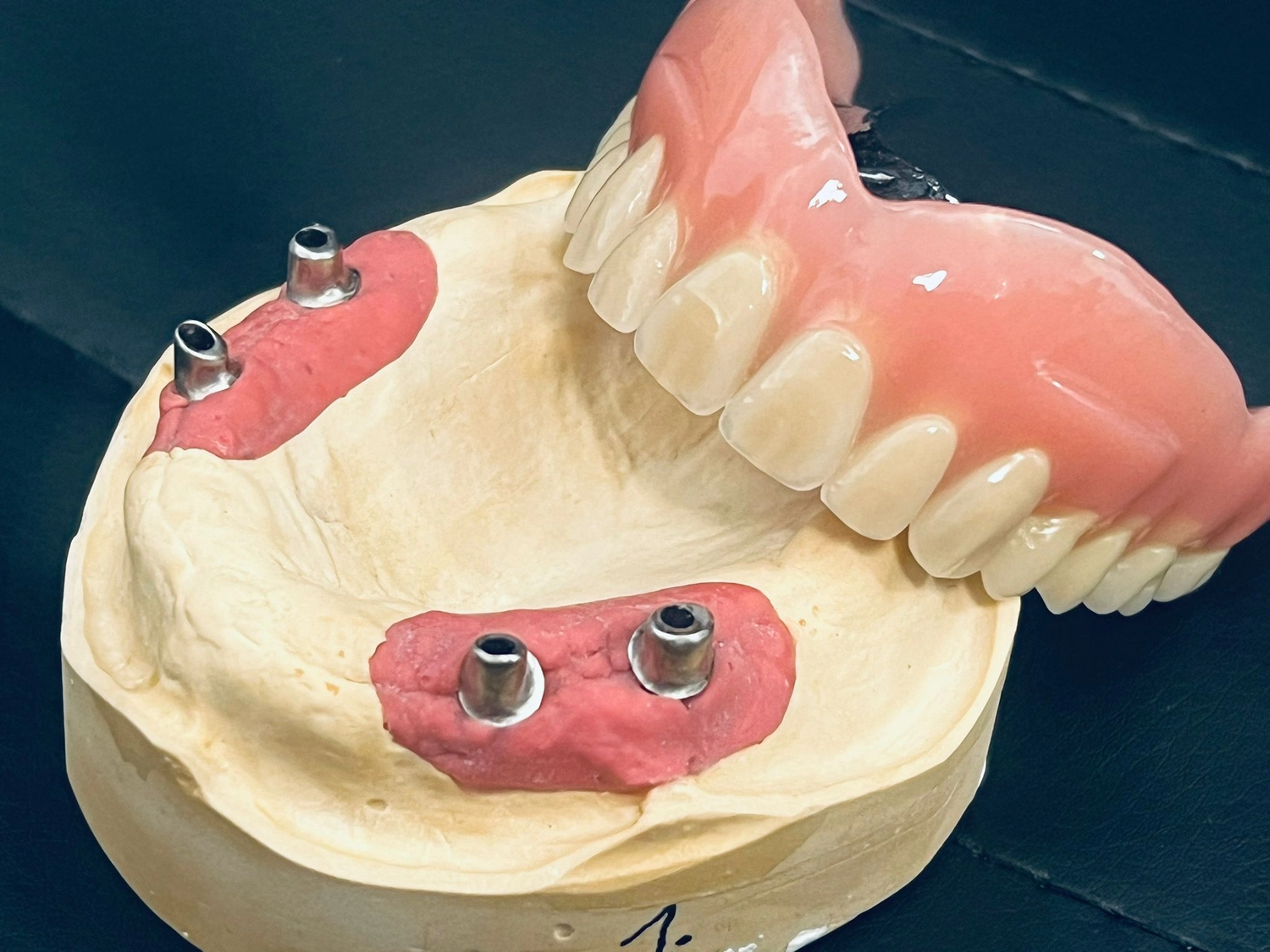 Kruse & Mordhorst Zahntechnik GmbH - Kronen & Brücken